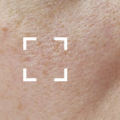 Dehydrated Skin