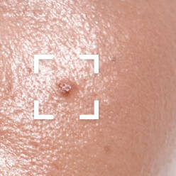 Oily Acne Prone Skin