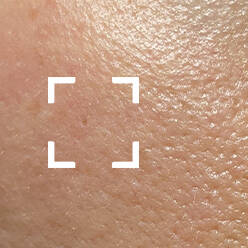 Uneven Skin Texture