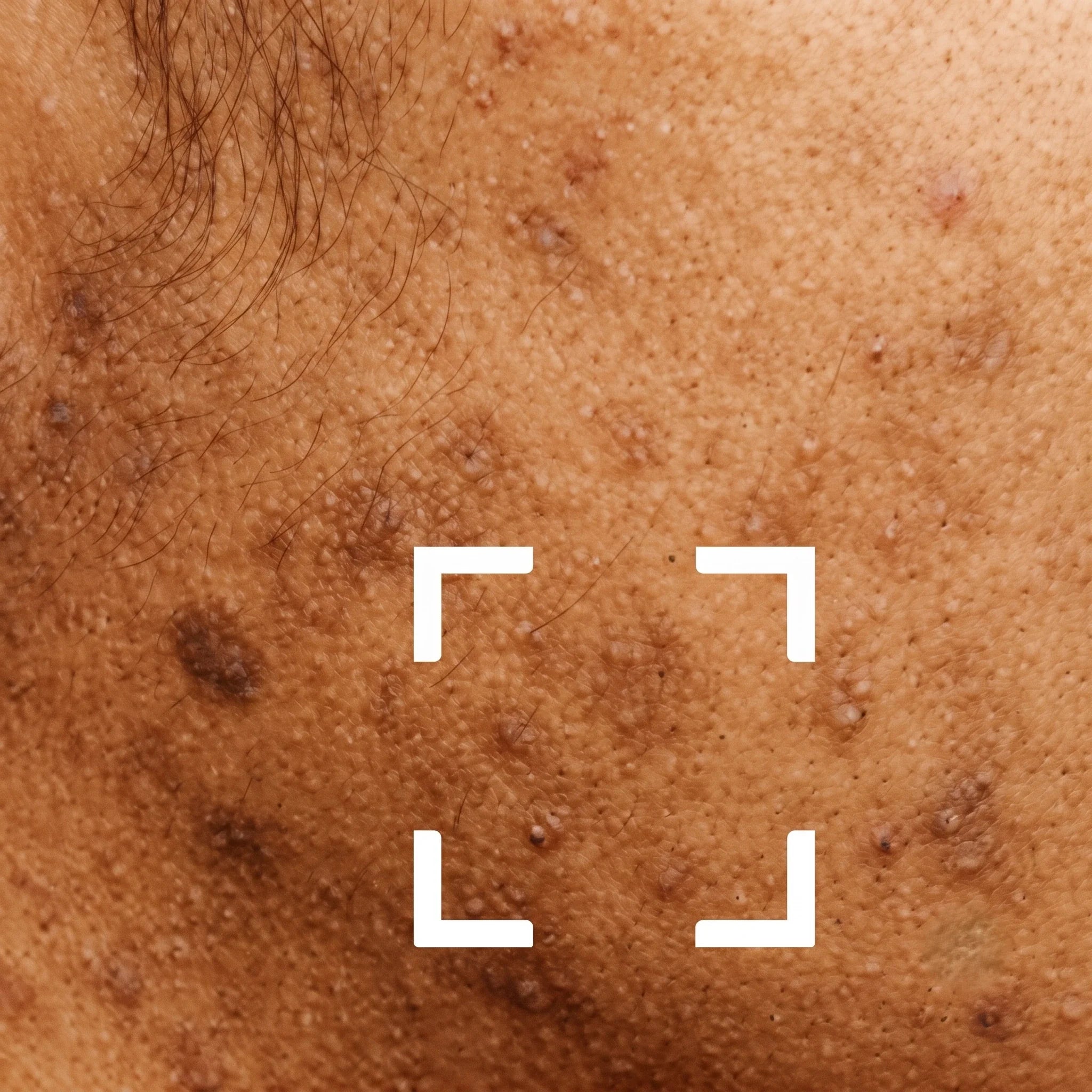 Skin Discoloration